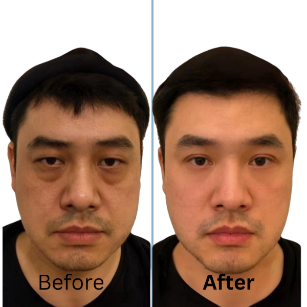 Trifecta Eyebag & Dark Circle